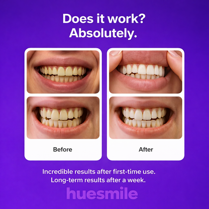 HueSmile Whitening Strips